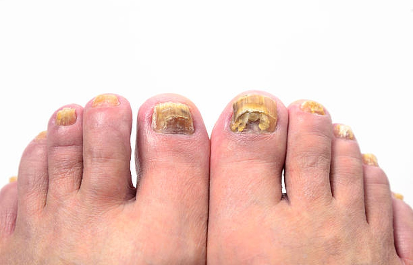 Balanced Breakfast Ideas for Fungal Nails